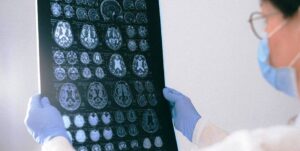 Read more about the article Type 3 Diabetes – Brain Damage