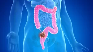 Read more about the article Colorectal Cancer and Diabetes: The Silent Connection No One Talks About