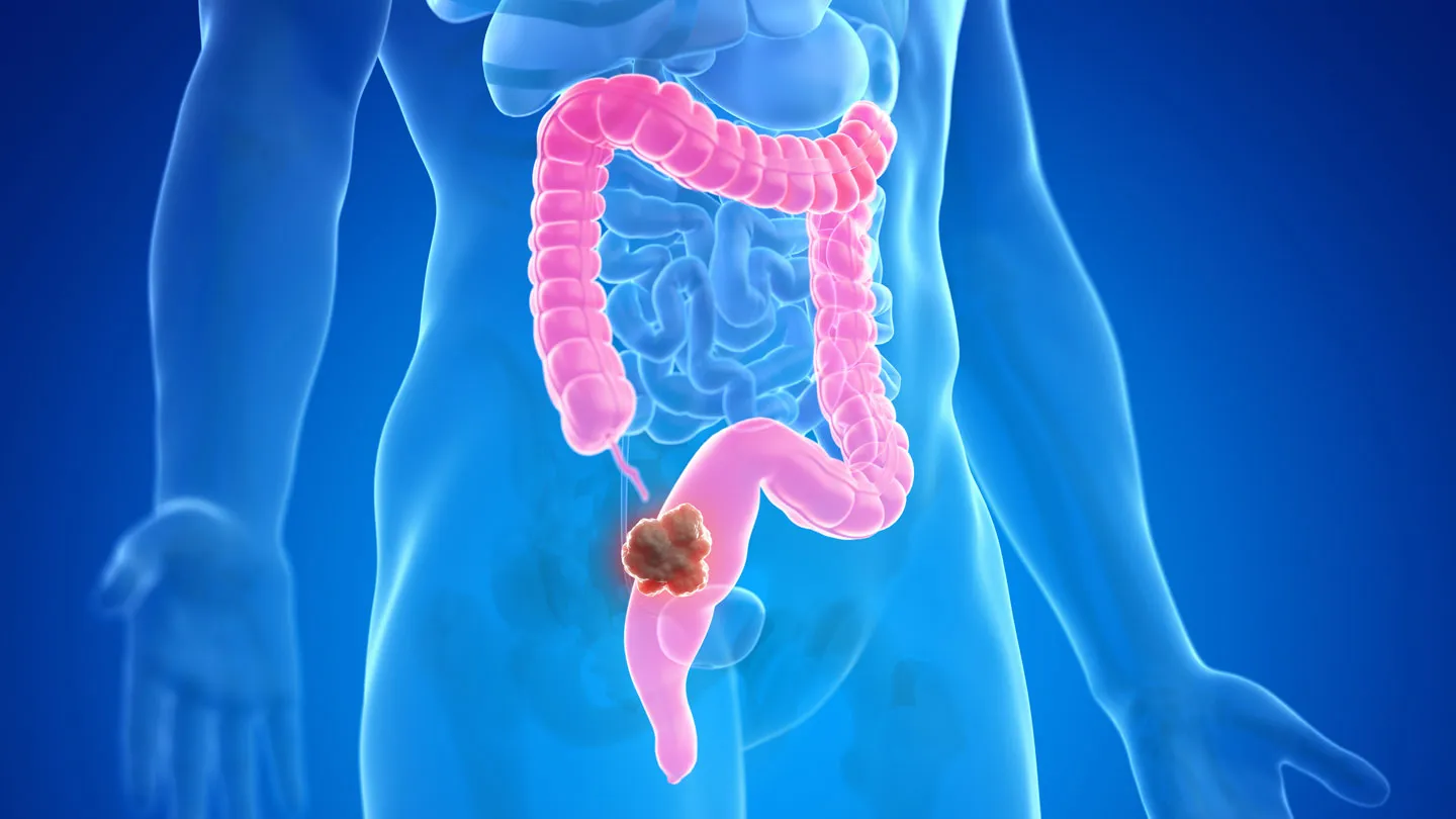Read more about the article Colorectal Cancer and Diabetes: The Silent Connection No One Talks About